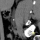 Ureterolithiasis: CT - Computed tomography